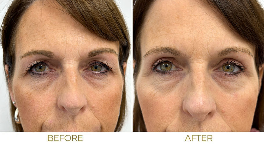 What Blepharoplasty Before and After Images Reveal About Healing