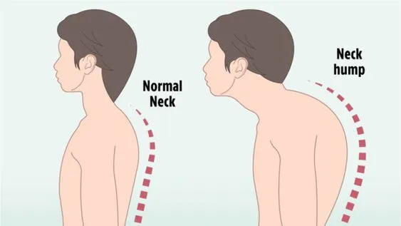 Daily Neck Hump Exercises for Better Posture and Less Pain