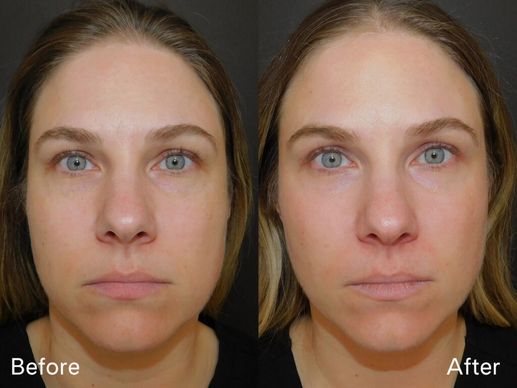 Moxi Laser Before and After: What 30 Days Really Looks Like